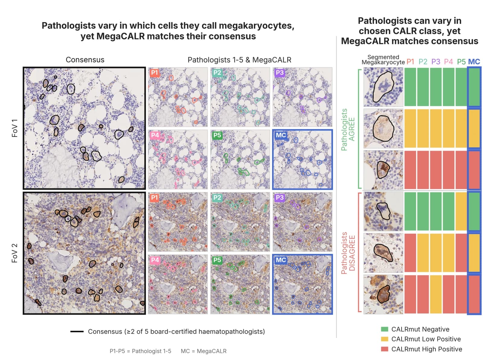 Two panels. Left: the same megakaryocytes segmented by each of five pathologists and by MegaCALR, showing the readers disagree on which cells to call megakaryocytes while MegaCALR matches their consensus. Right: a grid of how each pathologist and MegaCALR classified individual megakaryocytes as CALRmut Negative, Low Positive, or High Positive, with MegaCALR matching the consensus class.