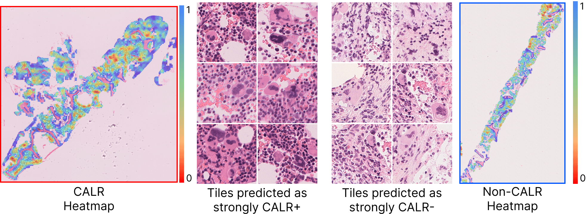 GTL EHA 2024 figure showing patches of bone marrow samples predictive of CALR mutations