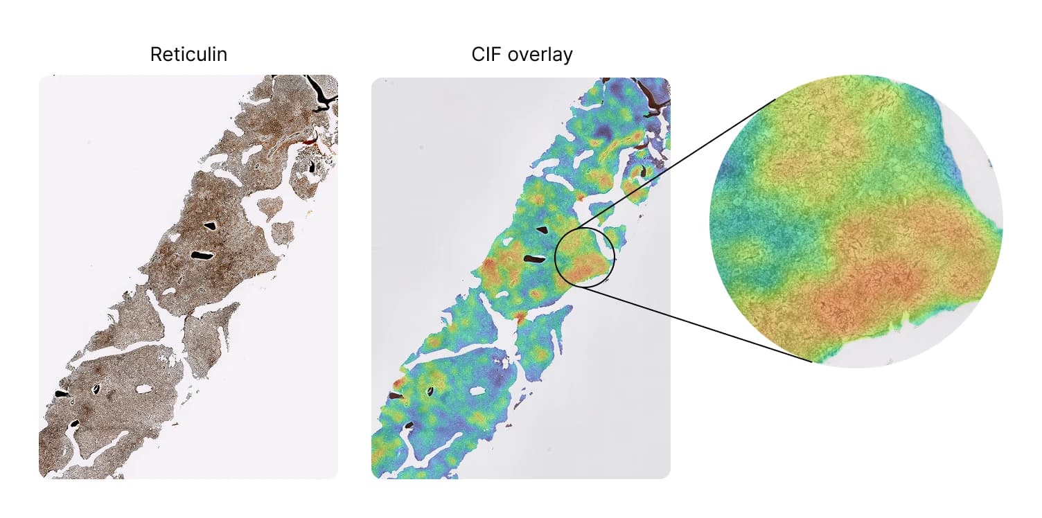 A reticulin-stained bone marrow biopsy next to the same biopsy overlaid with a CIF heatmap, with a magnified inset, where color indicates the continuous fibrosis score across the tissue.