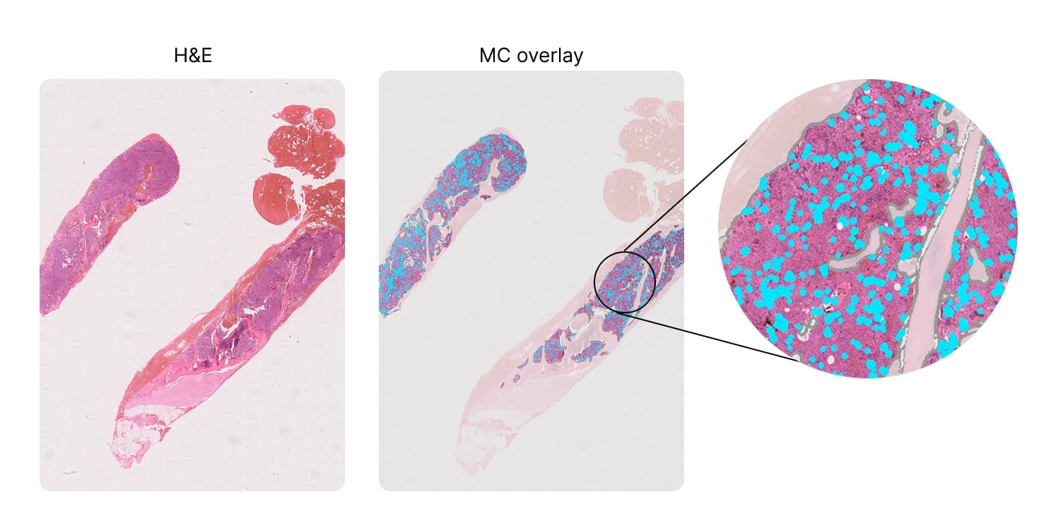 An H&E-stained bone marrow biopsy next to the same biopsy with AI-detected megakaryocytes segmented and overlaid, with a magnified inset, used to quantify megakaryocyte pleomorphism and spatial clustering.